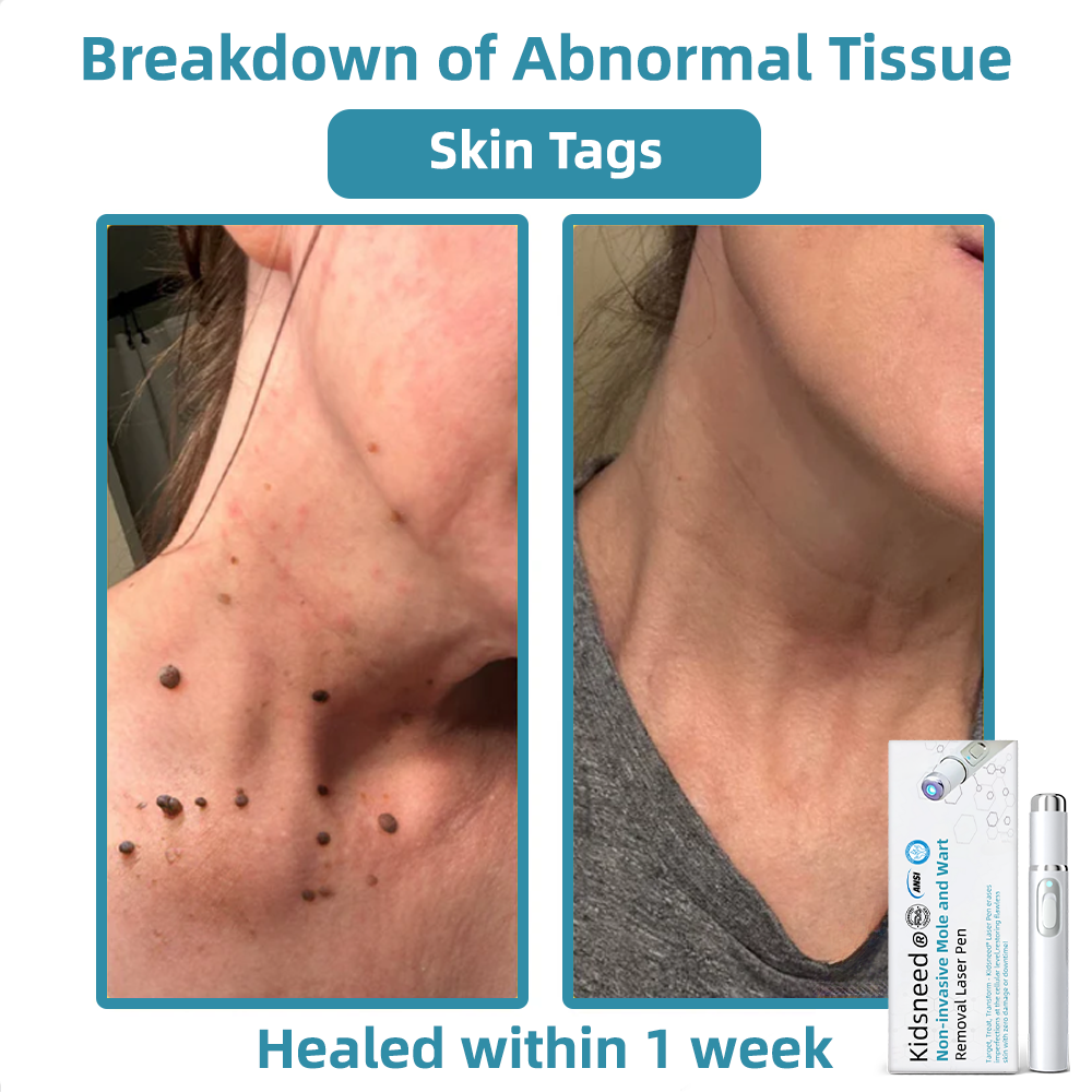 𝐤𝐢𝐝𝐬𝐧𝐞𝐞𝐝® ⚡𝑵𝒐𝒏-𝒊𝒏𝒗𝒂𝒔𝒊𝒗𝒆 𝑴𝒐𝒍𝒆 𝒂𝒏𝒅 𝑾𝒂𝒓𝒕 𝑹𝒆𝒎𝒐𝒗𝒂𝒍 𝑳𝒂𝒔𝒆𝒓 𝑷𝒆𝒏 𝑷𝙧𝒐𝒎𝒂𝒙🔥🔥🔥